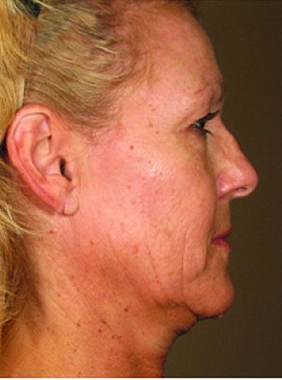 Cheek Fillerzz Before & After