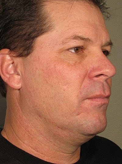 Cheek Fillerzz Before & After