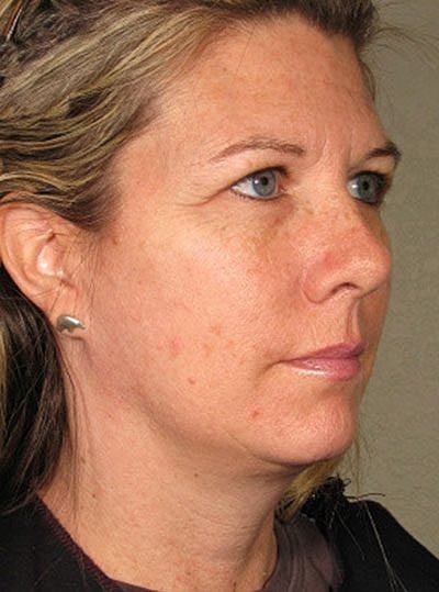 Cheek Fillerzz Before & After