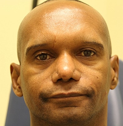 Cheek Fillerzz Before & After