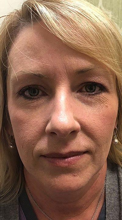 Cheek Fillerzz Before & After