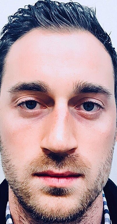 Cheek Fillerzz Before & After