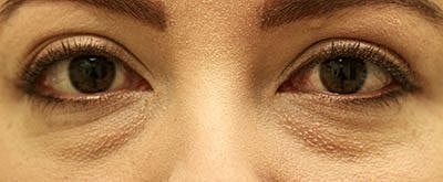 Cheek Fillerzz Before & After