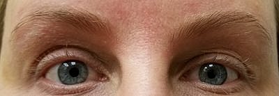 Cheek Fillerzz Before & After