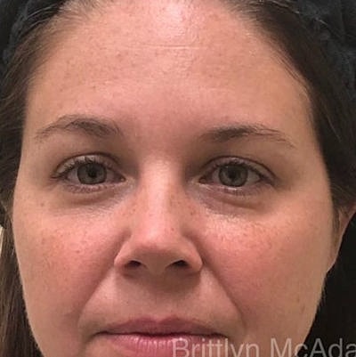 Cheek Fillerzz Before & After