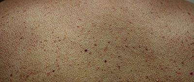 Cheek Fillerzz Before & After