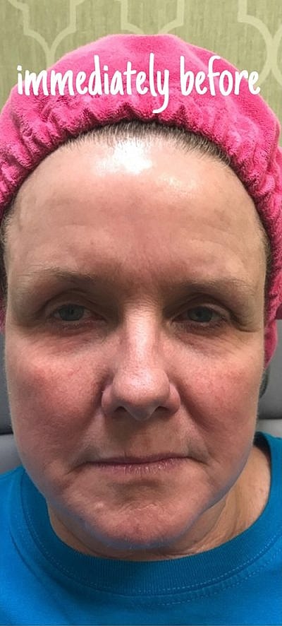 Cheek Fillerzz Before & After