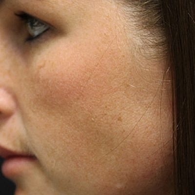 Cheek Fillerzz Before & After