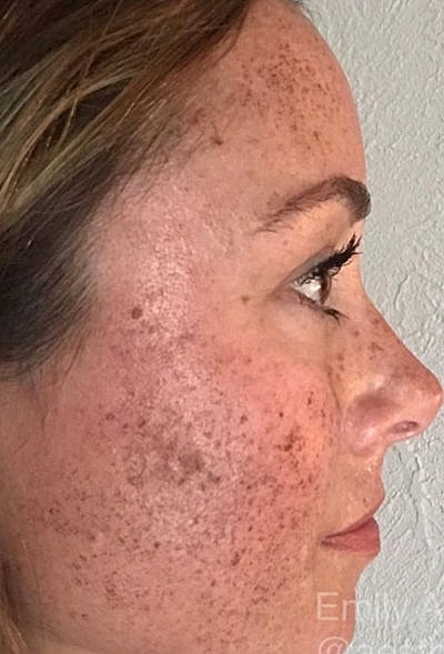 Cheek Fillerzz Before & After