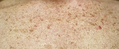 Cheek Fillerzz Before & After