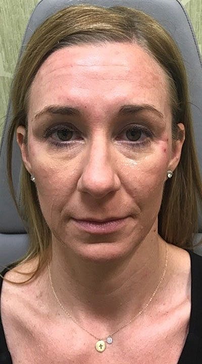 Cheek Fillerzz Before & After