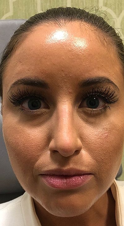 Cheek Fillerzz Before & After