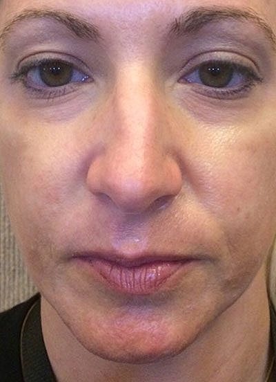 Cheek Fillerzz Before & After