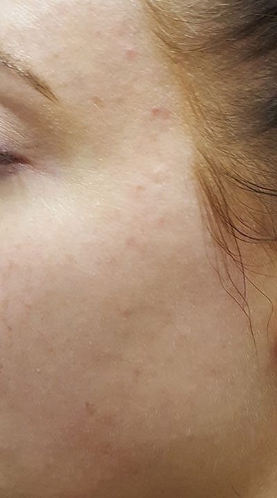 Cheek Fillerzz Before & After