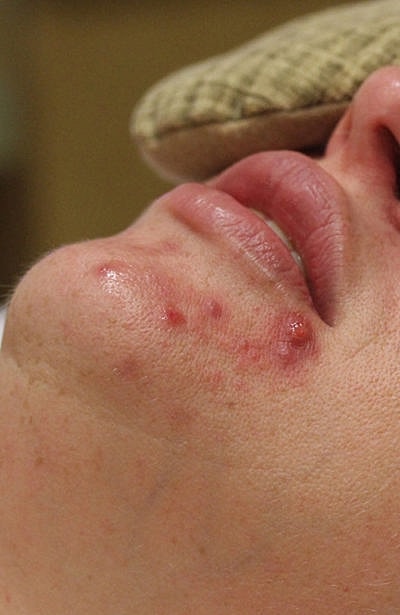 Cheek Fillerzz Before & After