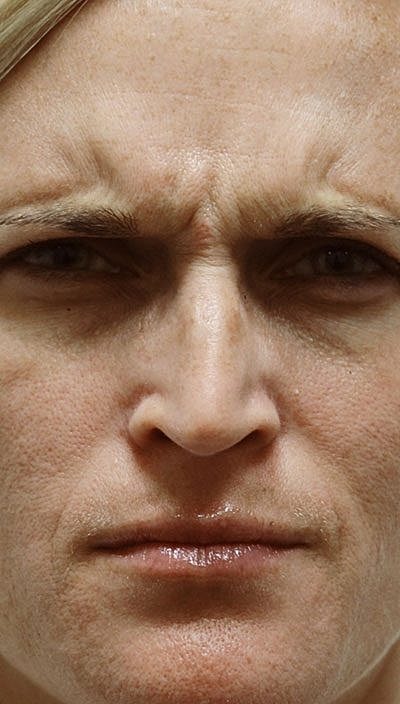 Cheek Fillerzz Before & After